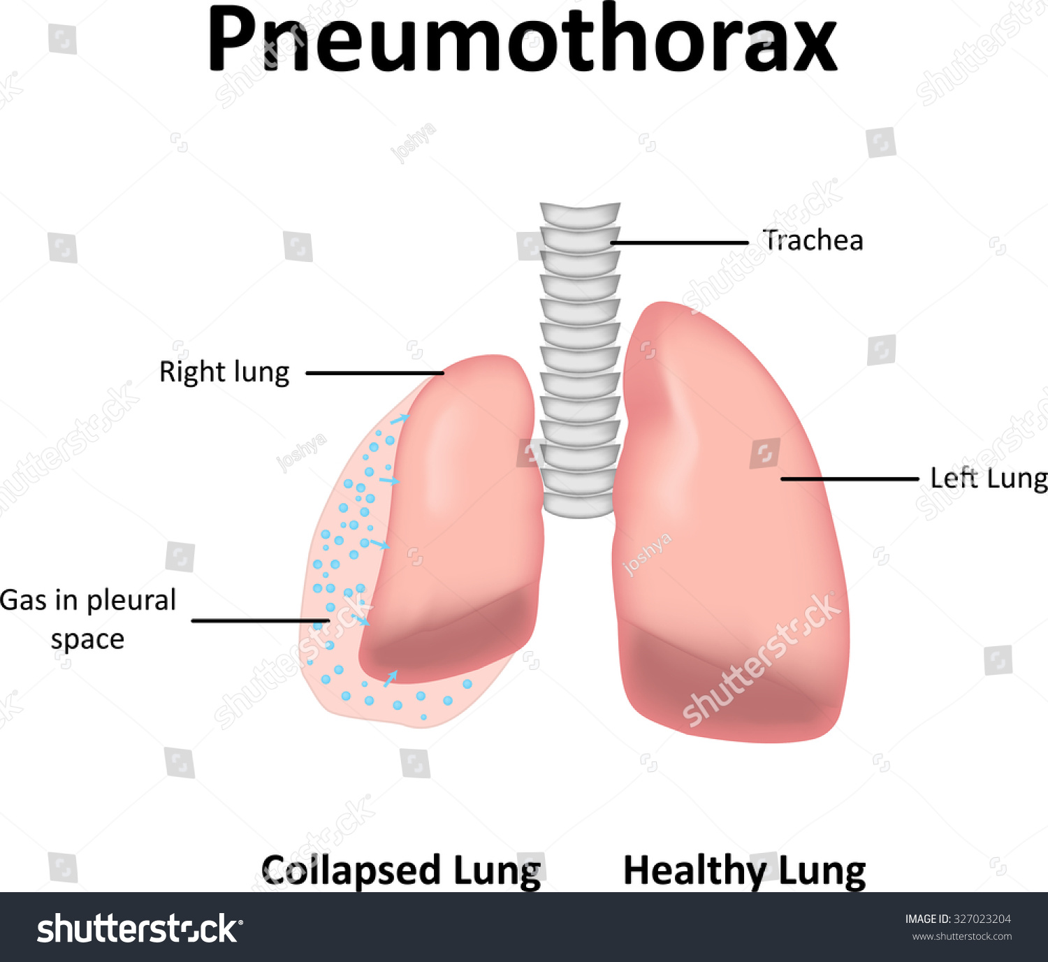 Pneumothorax