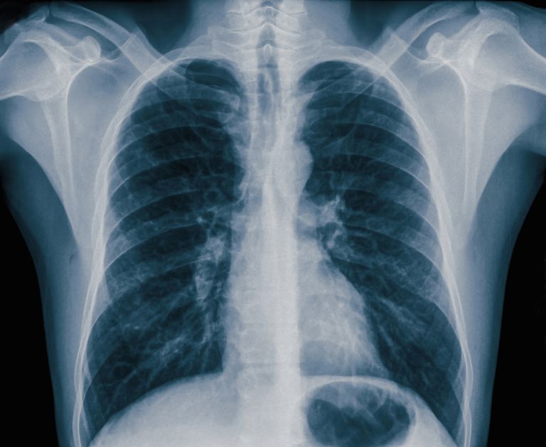 Pneumothorax