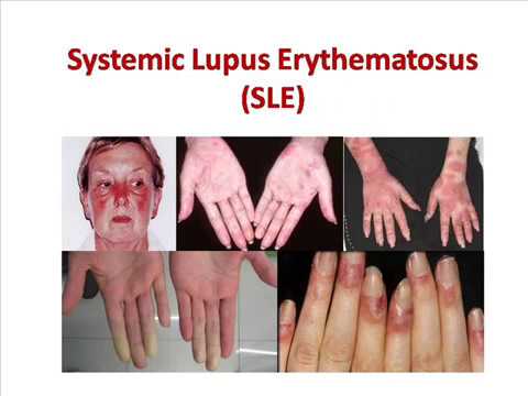 คำอธิบาย: Image result for sle